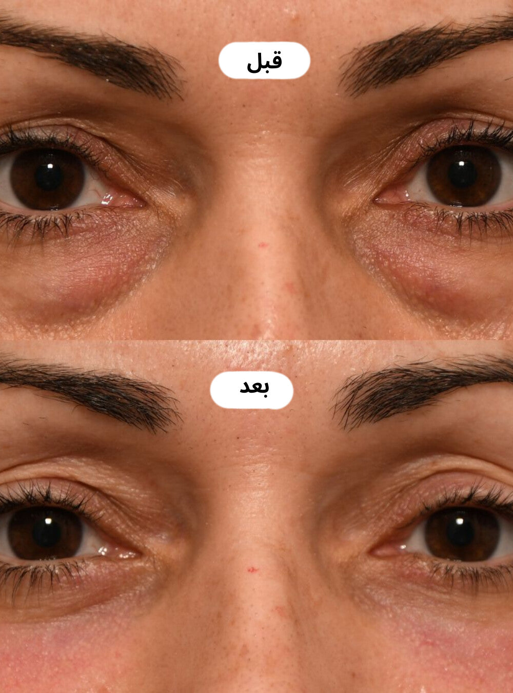 كريم العيون لمحاربة الهالات السوداء ,الانتفاخات والتجاعيد بتقنية الضوء الأحمر المتقدمة - ENAYA™